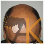 Before Hair Transplant