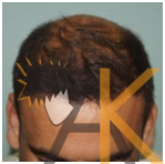 After Hair Transplant