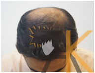 Before Hair Transplant