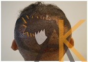 After Hair Transplant
