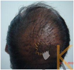 Immediate postop; grafted area1