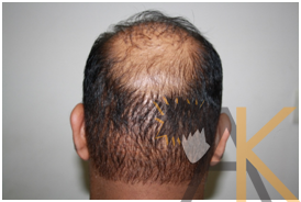 After our 1st FUE Session, no scars