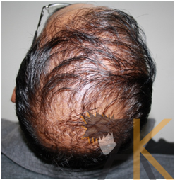 Immediate postop; grafted area