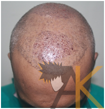 Immediate Post op after 2nd session front