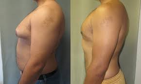 gynecomastia