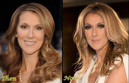 Celine-Dion Plastic Surgery