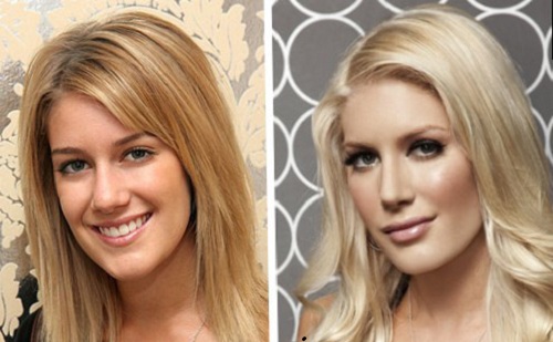 Heidi Montag plasctic surgery