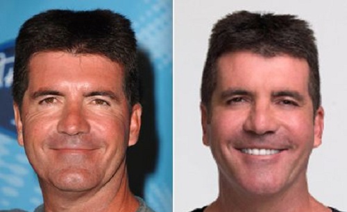 simon-cowell surgery before and after
