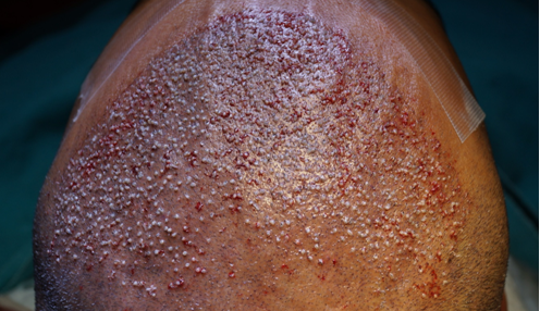 Picture of scalp immediately after implantation