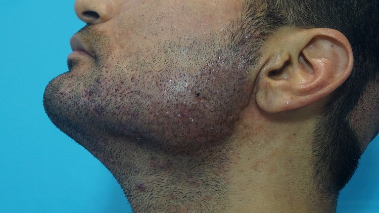 case study imm post op pic