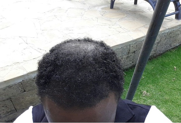 Curly Hair Patient Result 1