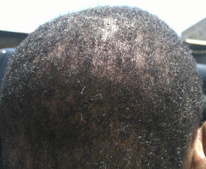 Curly Hair Patient Result 3