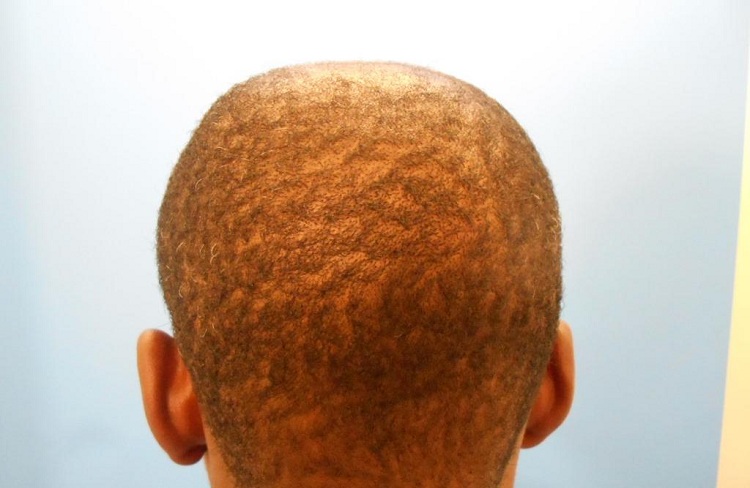 PreOp (4) Curly Hair Patient Result