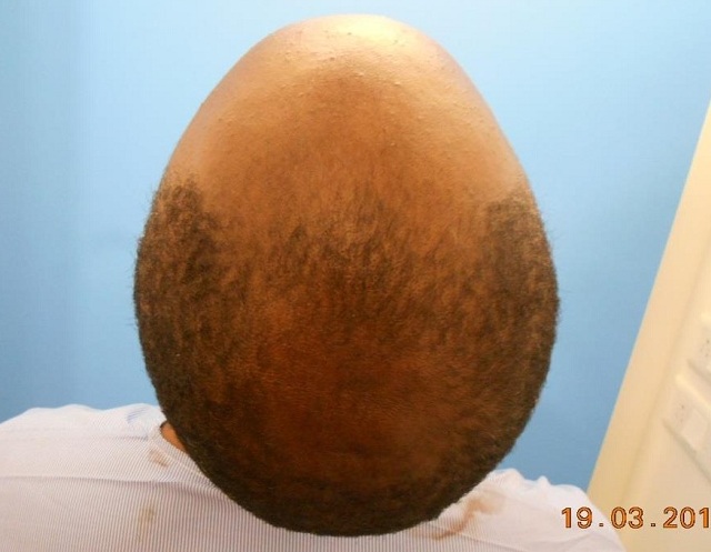 PreOp (5) Curly Hair Patient Result