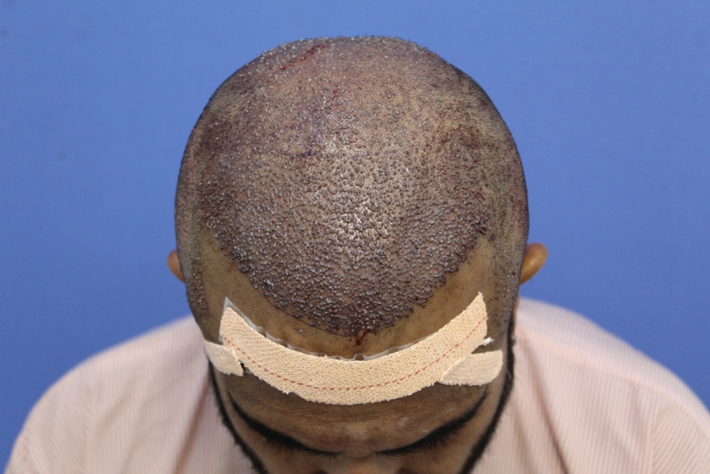 After FUT Hair Transplant